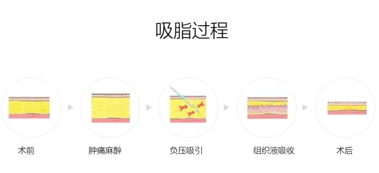 最新吸脂方法，探索瘦身新境界的神秘秘诀